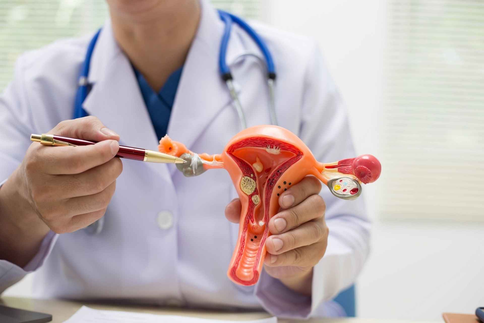 Cancer de l’ovaire : un suivi gynécologique, même après la ménopause, est primordial