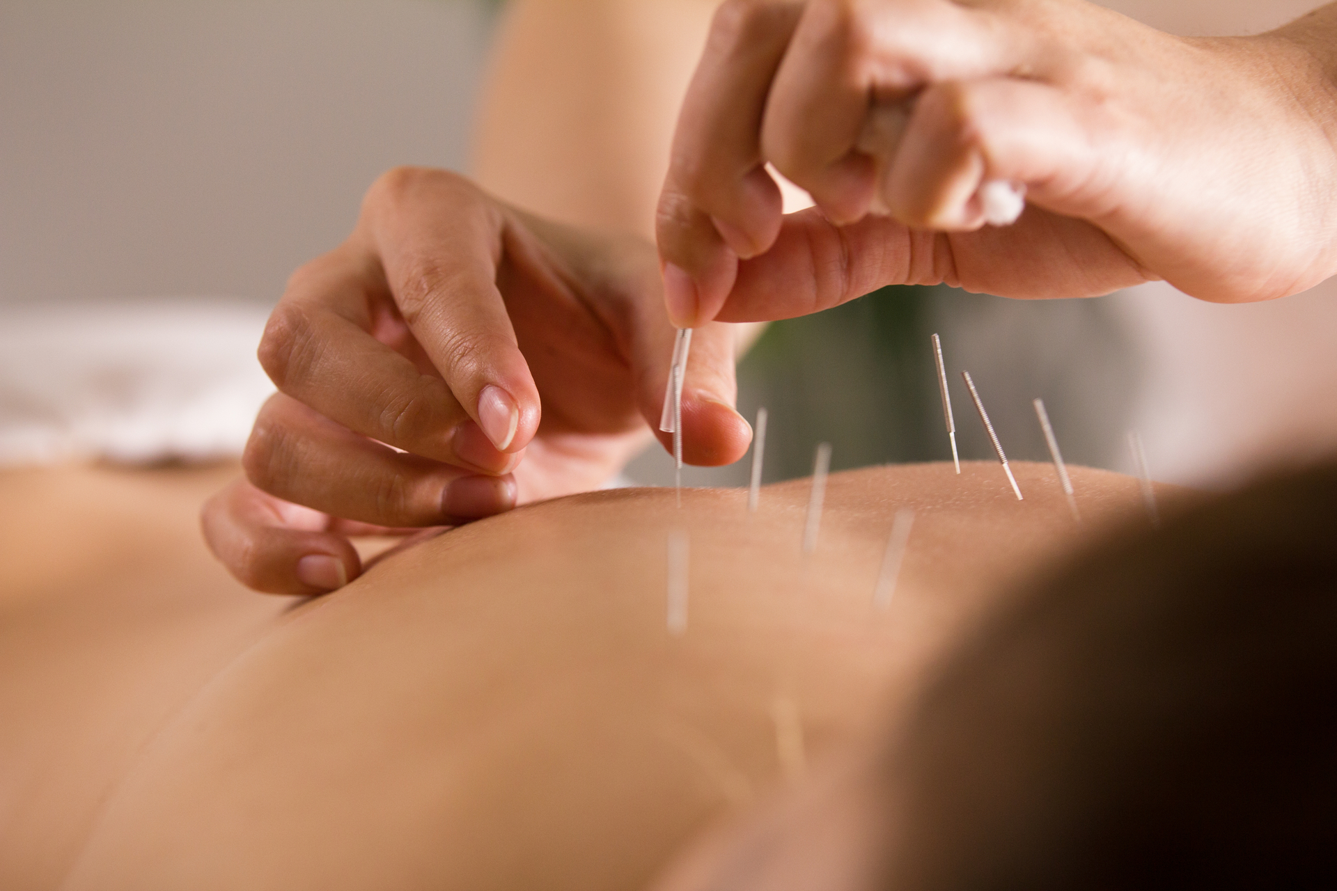 Acupuncture : que dit la science ?