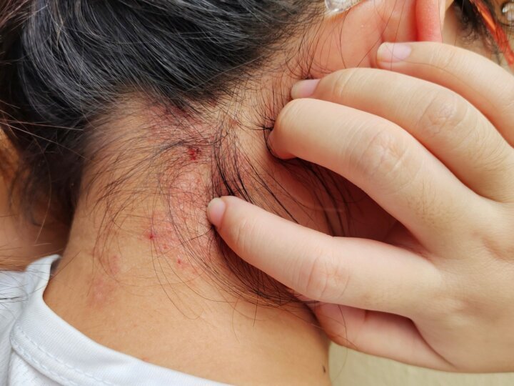 Psoriasis : une maladie de peau associée à plusieurs autres pathologies