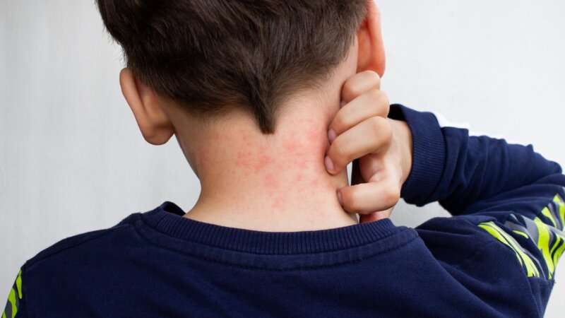 Pénicilline : une allergie confirmée dans seulement 10 % des cas