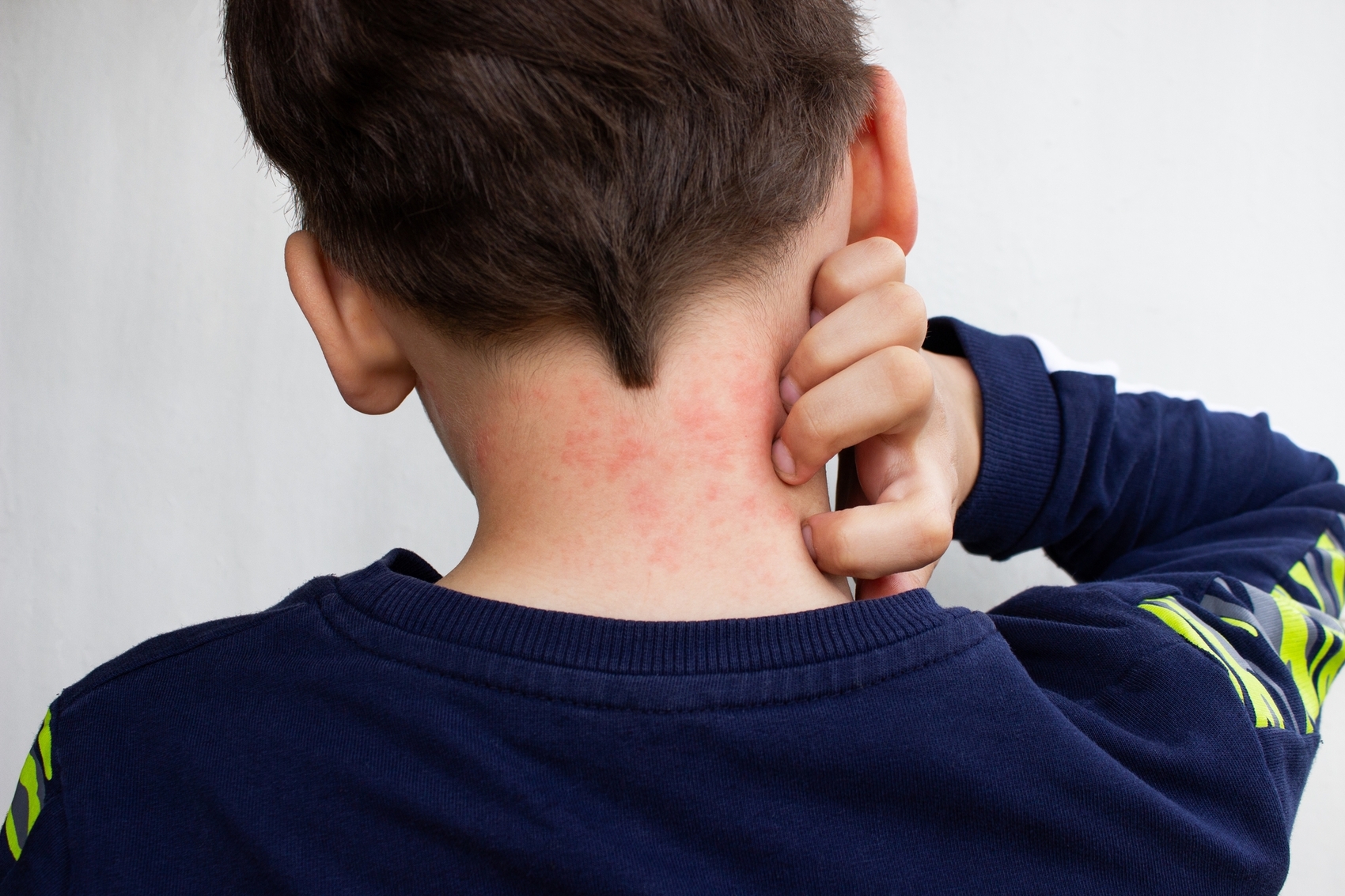 Pénicilline : une allergie confirmée dans seulement 10 % des cas