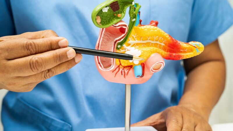 Cancer du pancréas : bientôt le 2ème cancer le plus meurtrier