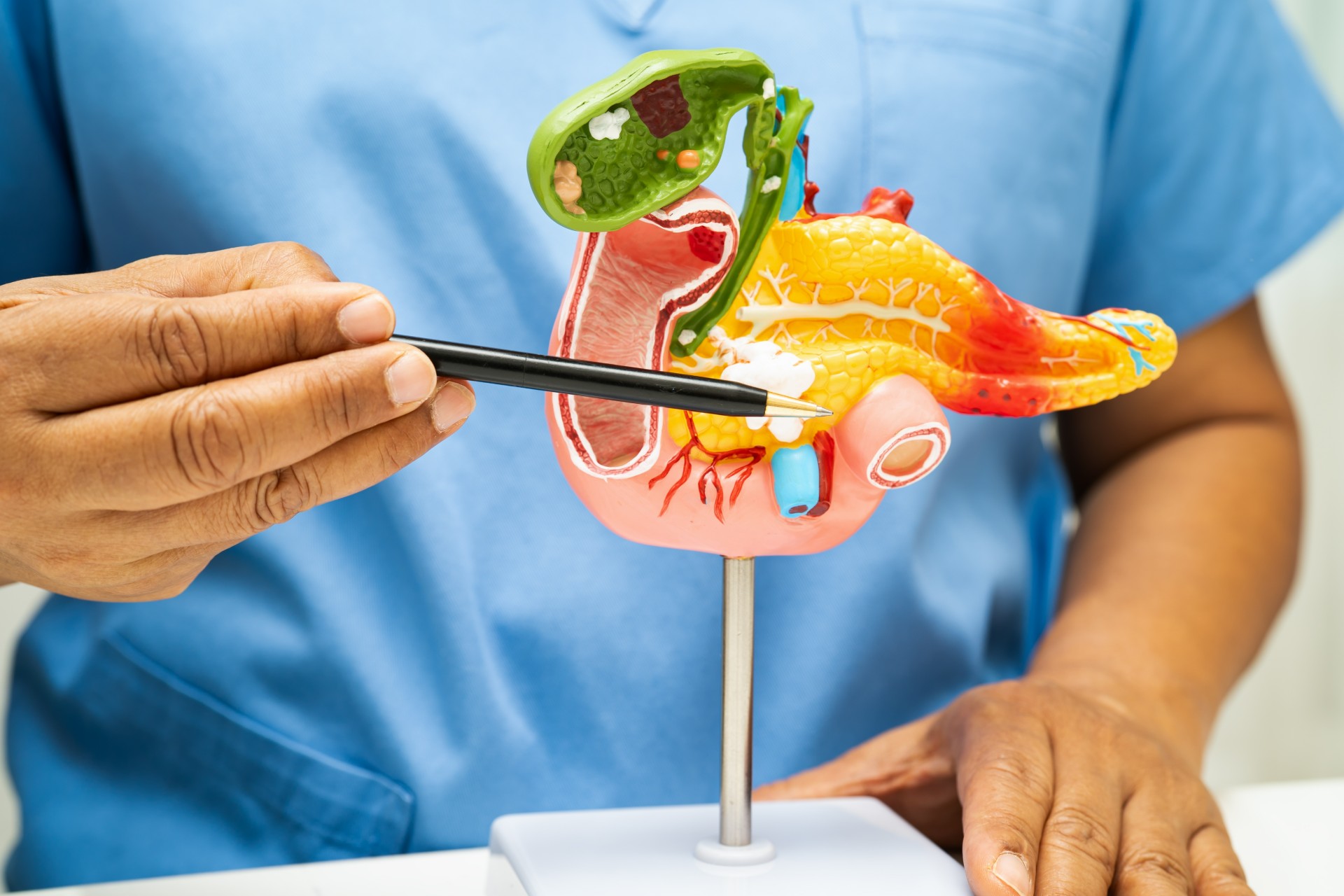 Cancer du pancréas : bientôt le 2ème cancer le plus meurtrier