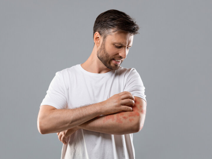 Six nouveaux biomédicaments dans la dermatite atopique, pour qui ?