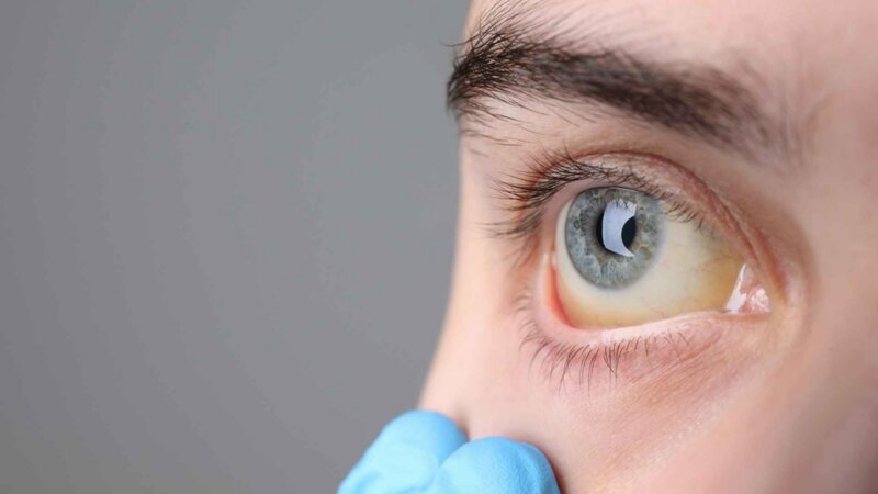 Il vomit au Sénat : qu’est-ce que le « syndrome de Gilbert » dont souffre Pierre Ouzoulias