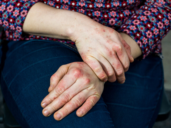 Eczéma chronique des mains : une maladie qui percute la vie professionnelle