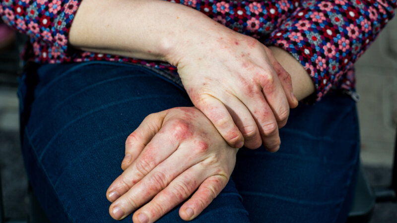Eczéma chronique des mains : une maladie qui percute la vie professionnelle
