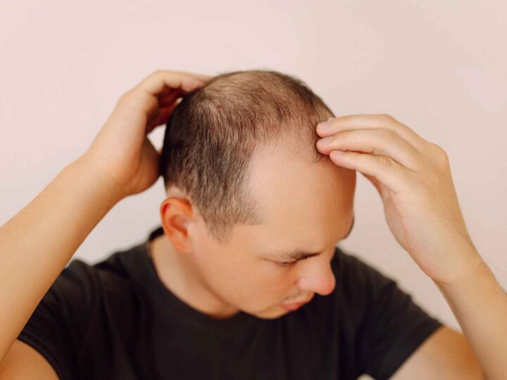 Chute des cheveux : bientôt un traitement efficace contre la calvitie ?