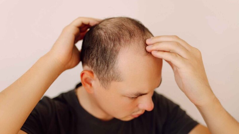 Chute des cheveux : bientôt un traitement efficace contre la calvitie ?