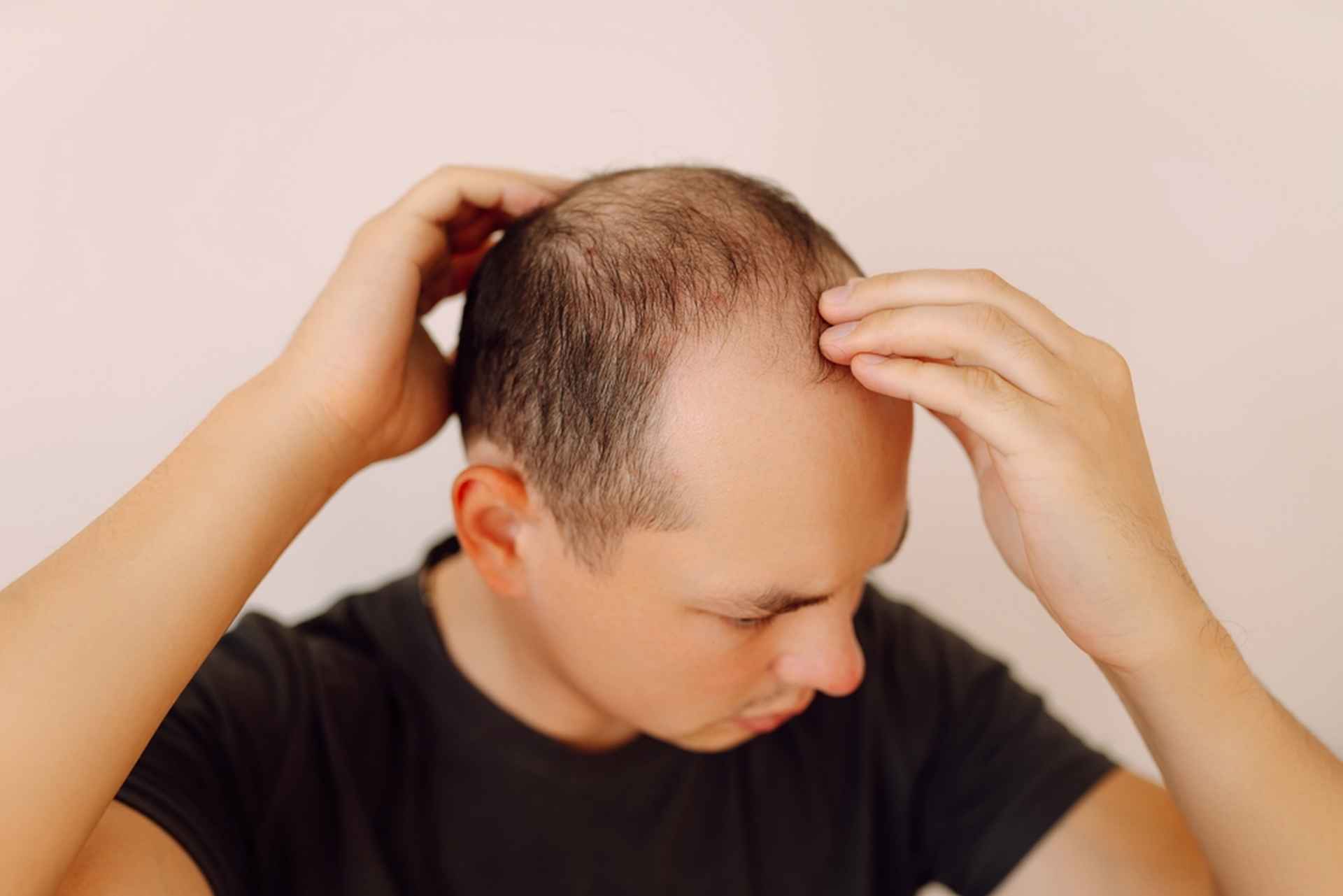 Chute des cheveux : bientôt un traitement efficace contre la calvitie ?