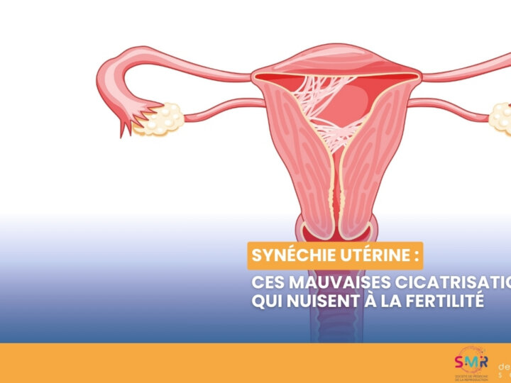 Synéchie utérine : ces mauvaises cicatrisations qui nuisent à la fertilité (Vidéo)