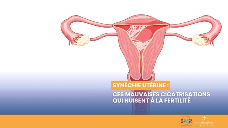 Synéchie utérine : ces mauvaises cicatrisations qui nuisent à la fertilité (Vidéo)
