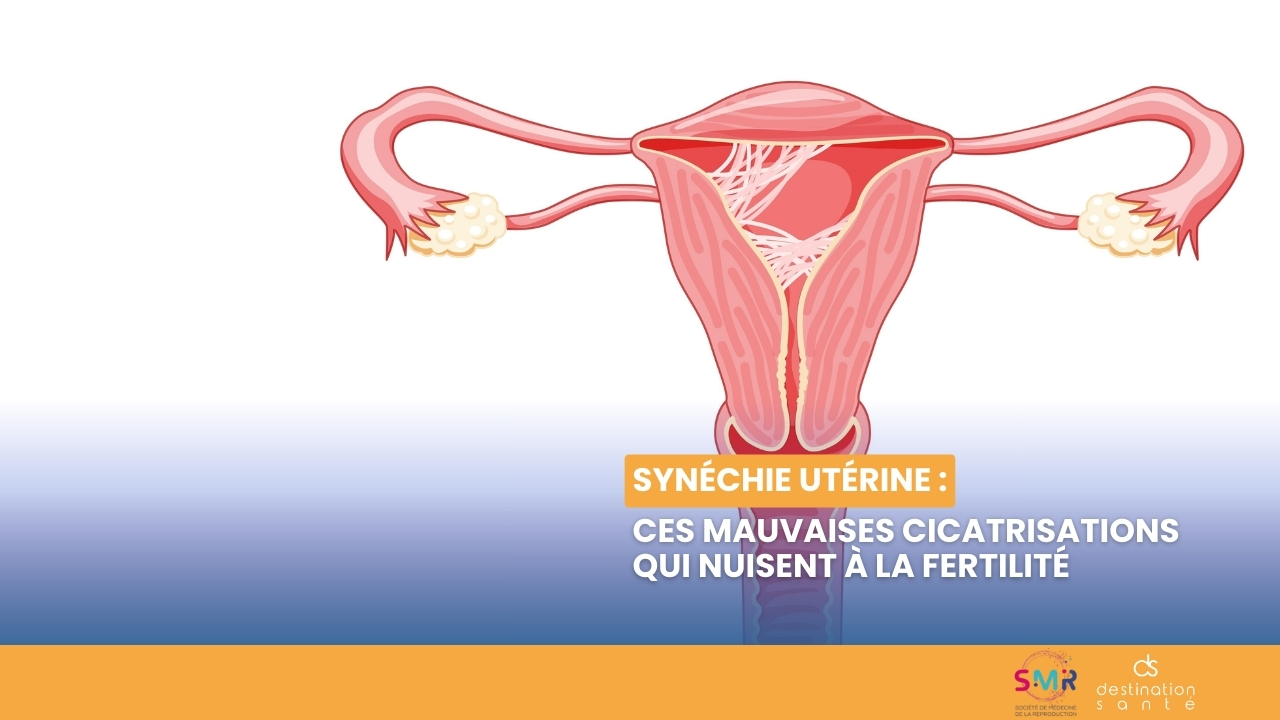 Synéchie utérine : ces mauvaises cicatrisations qui nuisent à la fertilité (Vidéo)