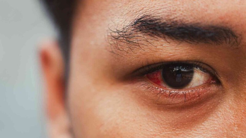 Qu’est-ce qu’une hémorragie sous-conjonctivale ?