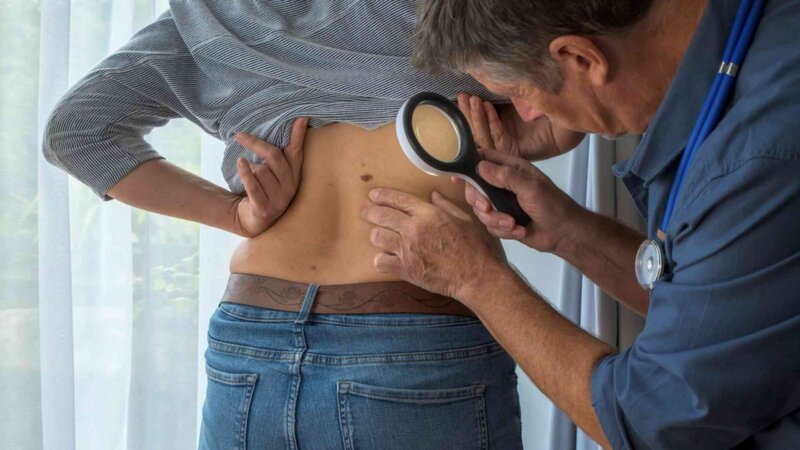 Cancer de la peau : plus fréquent mais mieux traité, le double visage du mélanome