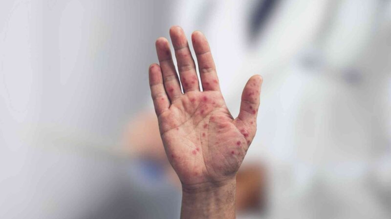Syndrome pieds-mains-bouche : les adultes peuvent-ils être touchés ?