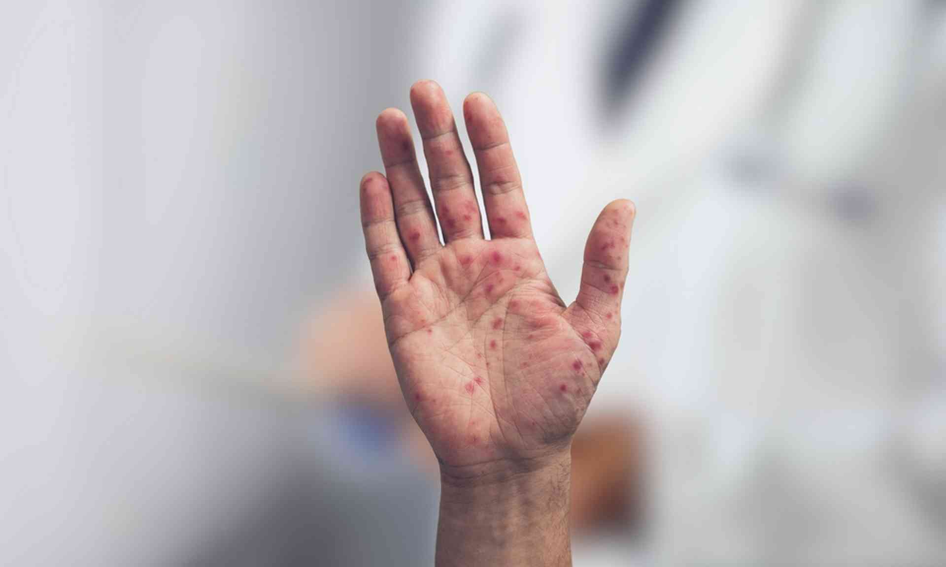 Syndrome pieds-mains-bouche : les adultes peuvent-ils être touchés ?