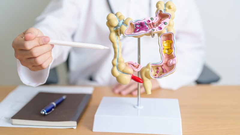 Cancer colorectal : quels sont les 3 comportements protecteurs et les 3 à éviter ?  